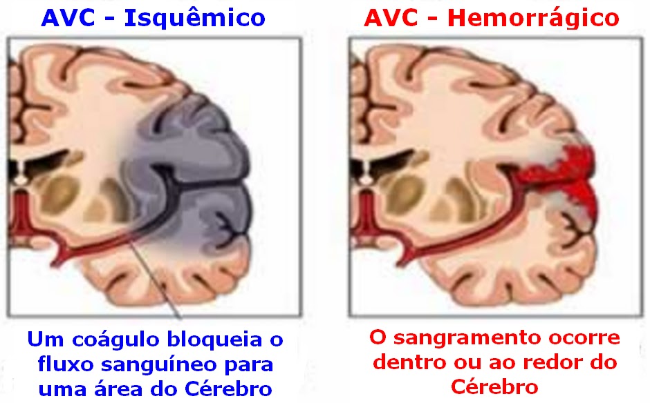 Bombeiroswaldo Bom saber 1 AVC Acidente vascular cerebral AVE Acidente Vascular Bombeiroswaldo Bom saber 1 AVC Acidente vascular cerebral AVE Acidente Vascular