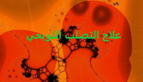 اسباب التصلب اللويحي