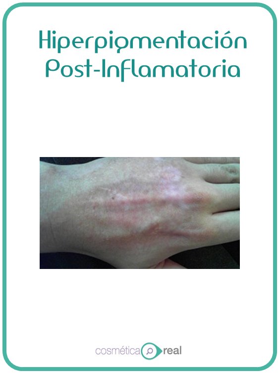 Hiperpigmentacion post inflamatoria: Porque tus manchas se oscurecen con el tratamiento, el temido efecto rebote