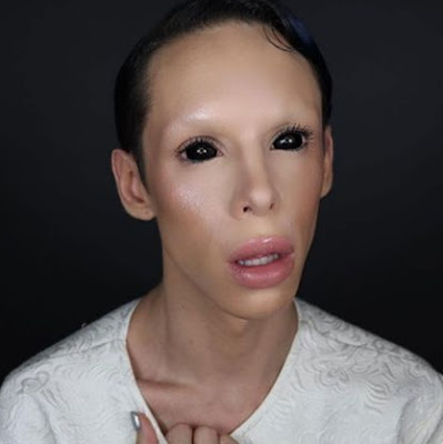 Vinny Ohh after surgery picture