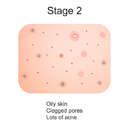 stage two acne