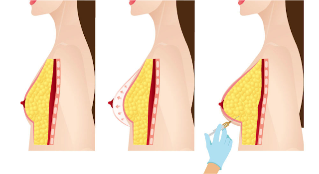 fat transfer breast augmentation cost malaysia