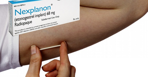implanon nexplanon insertion effects removal side