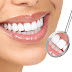 Teeth Whitening | Teeth Whitening Services | Teeth Bleaching Dentist