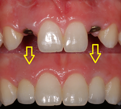 Kỹ thuật cấy ghép răng implant là gì? 1