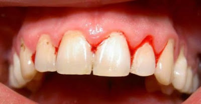 Viêm chân răng nên ăn gì? Điều trị dứt điểm 1
