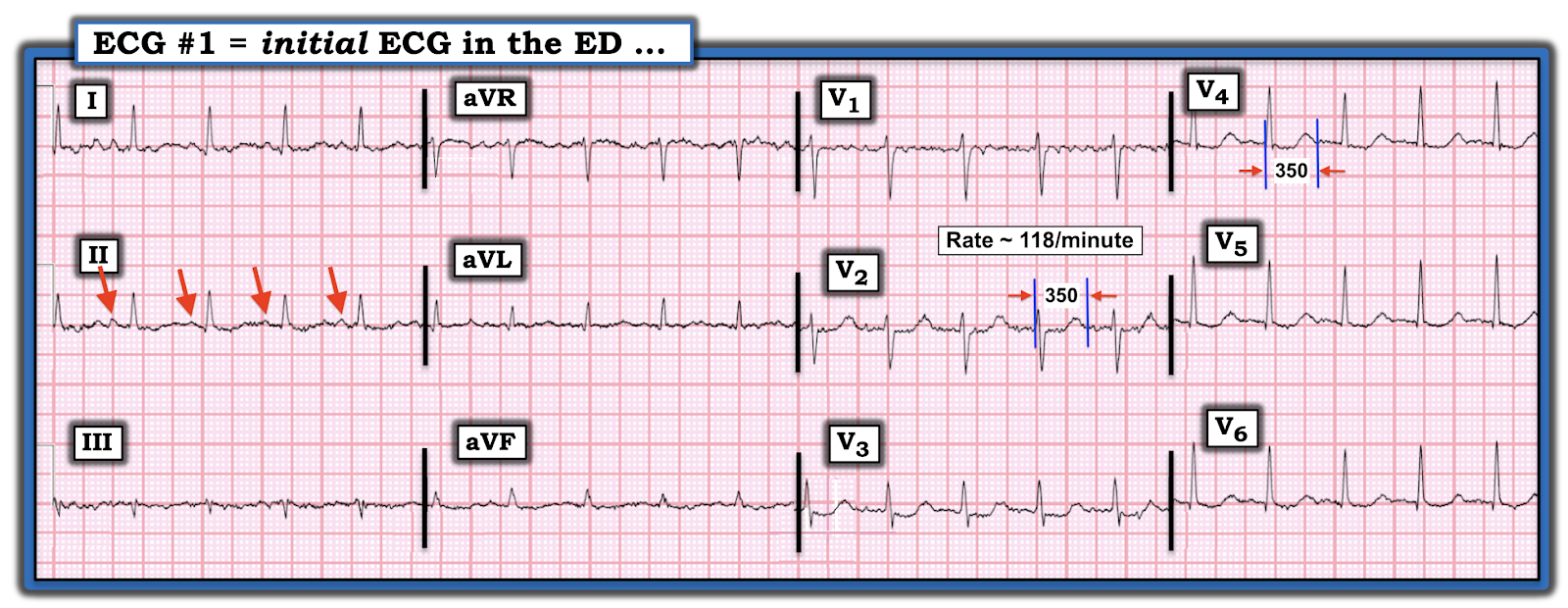 Dr. Smith's ECG Blog This patient has a severe electrolyte abnormality