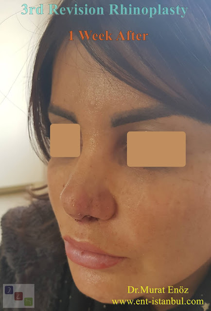 1 week after - 3rd Revision Rhinoplasty - Nostril Stenosis and Pollybeak Deformity - Complication Nose Surgery