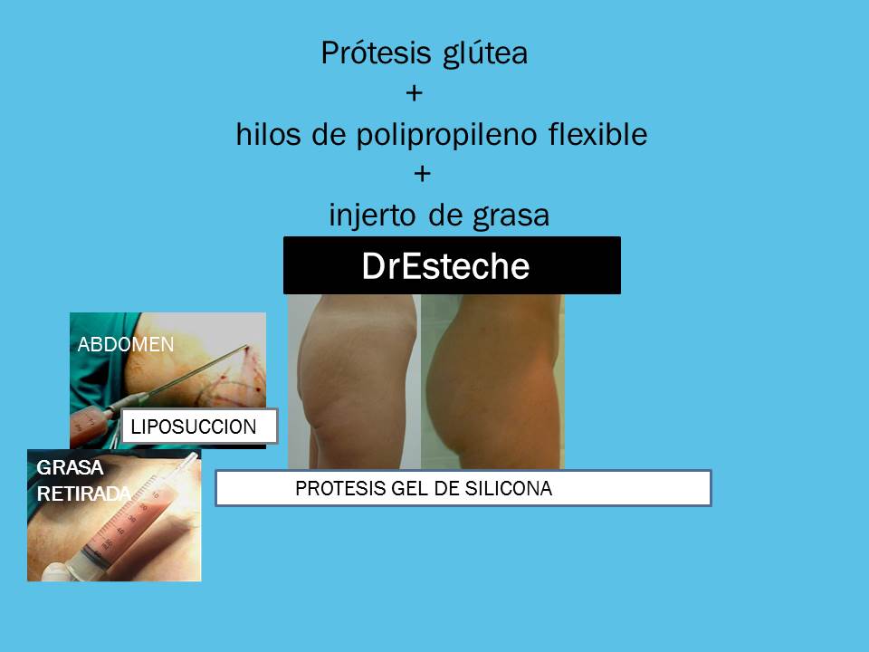 Dr. Esteche, Cirugía Plástica de Glúteos, Buttocks surgery: GLUTEAL  AUGMENTATION, part 12, AUMENTO DE GLUTEOS, PROTESIS DE GEL DE SILICONA, CIRUGIA DE GLUTEOS