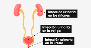 Infeccion urinaria