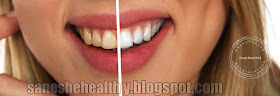 Before & after applying magical teeth whitening trick.