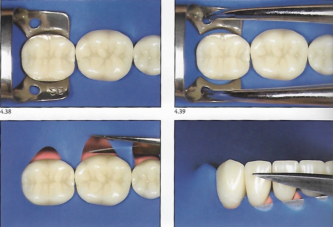 Rubber dam isolation in the posterior segment Dental Esthetics