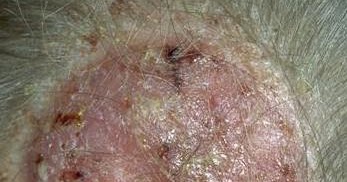 La diabetes las uñas de los dedos del pie el tratamiento