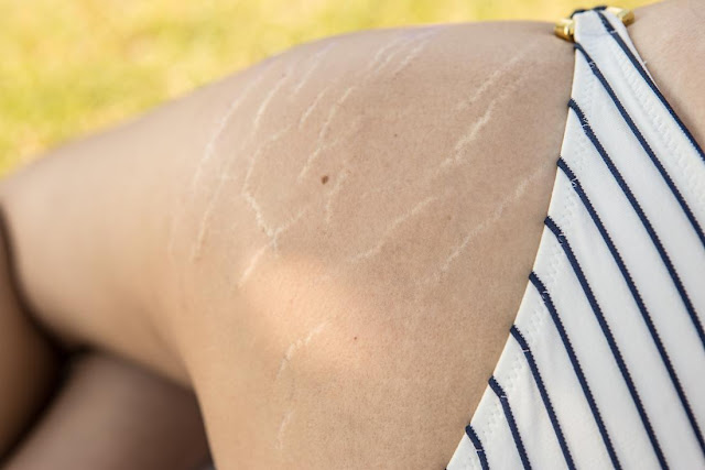 Stretch Marks on arms