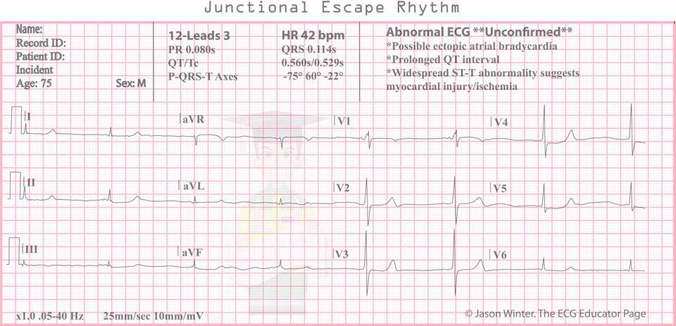 treatments for junctional escape rhythm treatments for junctional escape rhythm