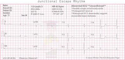 treatments for junctional escape rhythm treatments for junctional escape rhythm