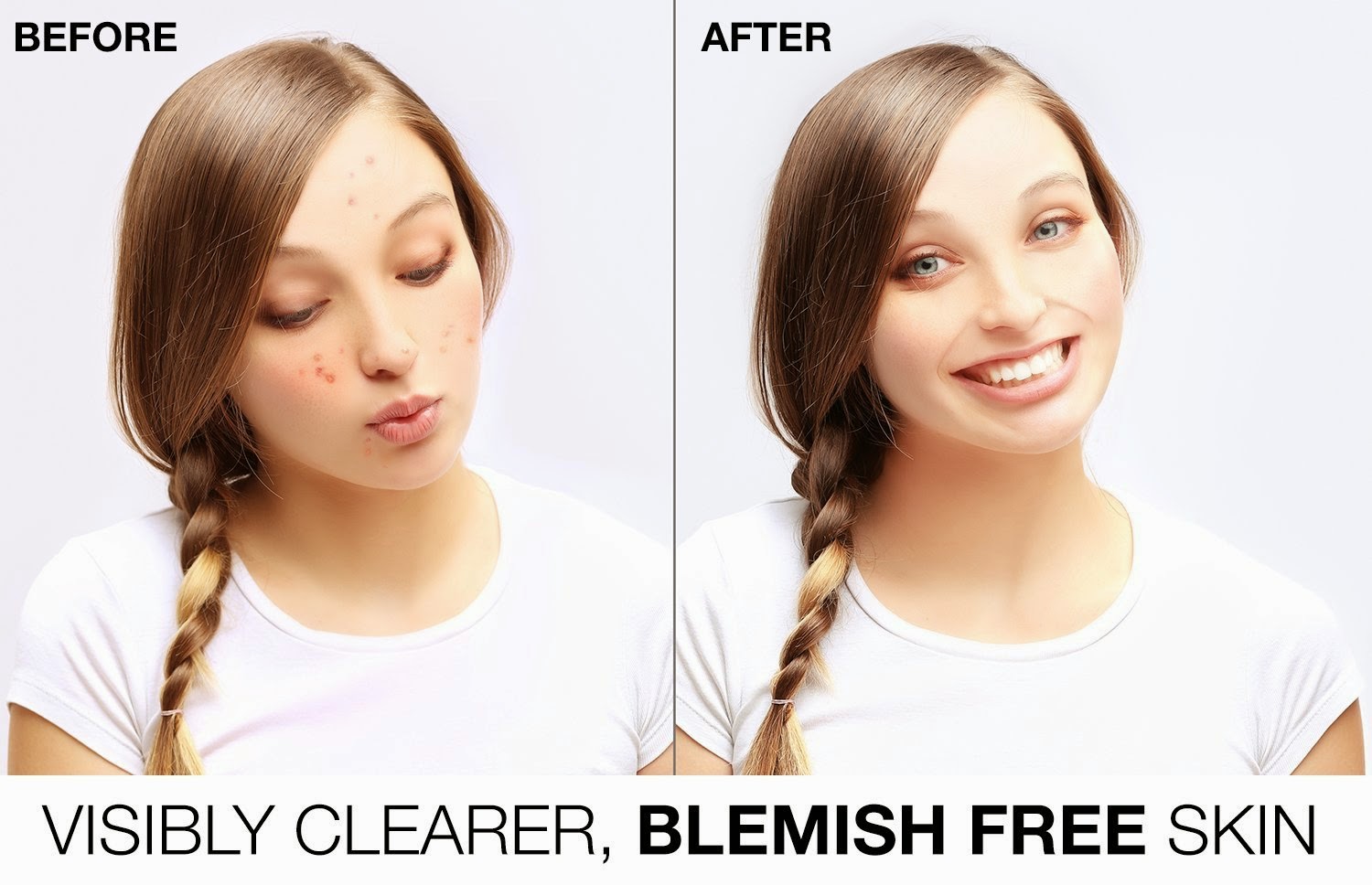 A Fast Acne Treatment with Chemical Peels Skin Bleaching