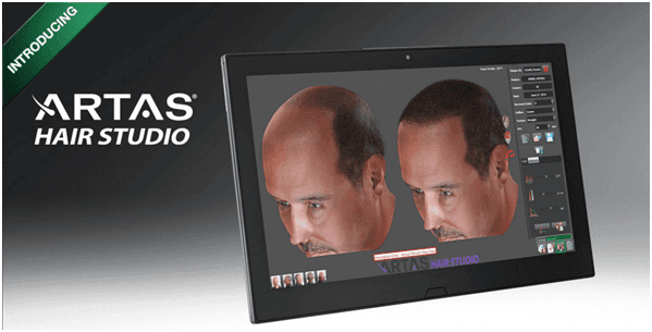 戰勝雄性禿基因　植髮機器人恢復期短、提升毛囊存活率