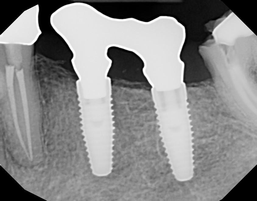 Dental Info how to make a sure fire solder index for an impant bridge