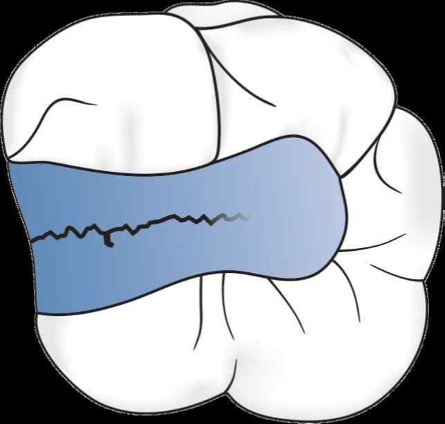 Cracked Tooth Syndrome Detailed Explanation!!