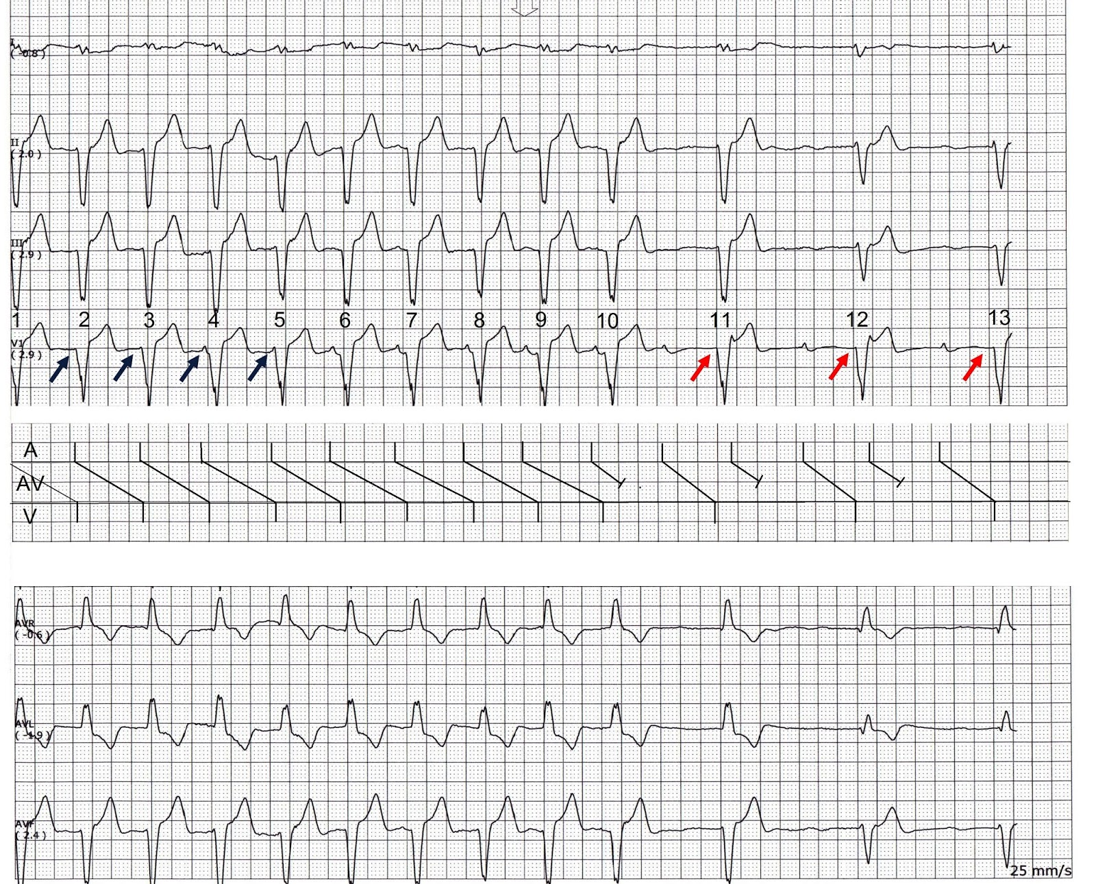 ECG Rhythms The "skipping" P waves