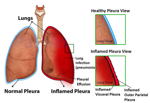 Pleurisy