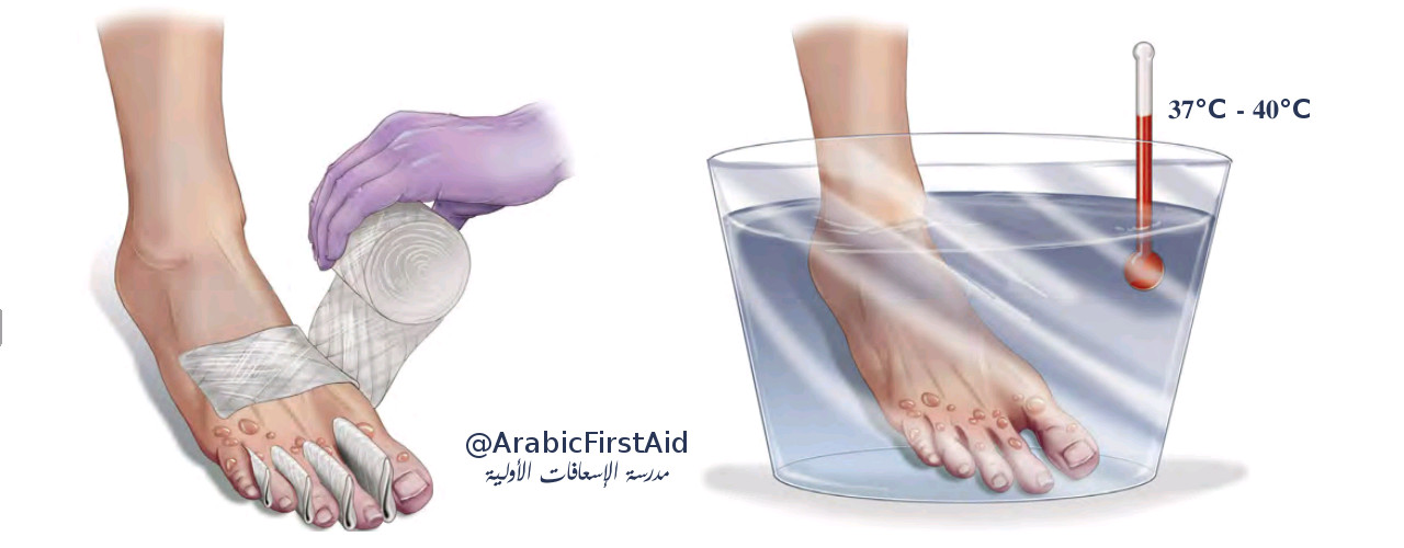 إسعاف قضمة الصقيع أو عضة الثلج مدرسة الاسعافات الاولية