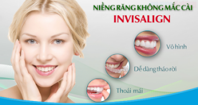 Dịch vụ niềng răng không mắc cài Invisalign