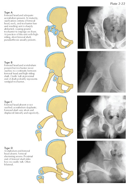 RADIOGRAPHIC CLASSIFICATION OF PROXIMAL FEMORAL FOCAL DEFICIENCY
