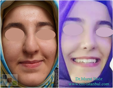 Nose Job in İstanbul, Turkey - Rhinoplasty Female Women