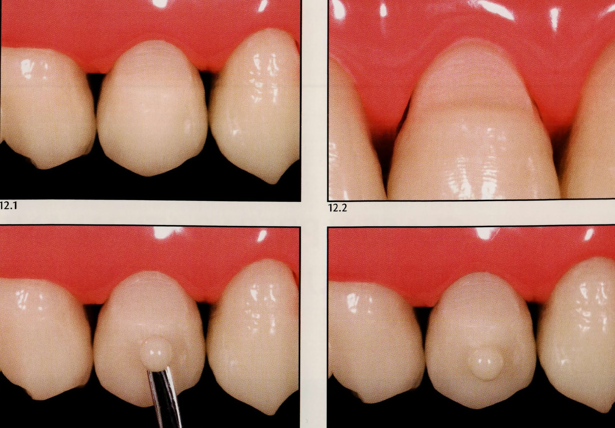Class V composite restoration " Noncarious lesion " Dental Esthetics