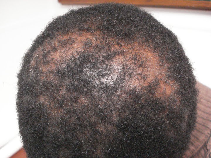 ccca alopecia