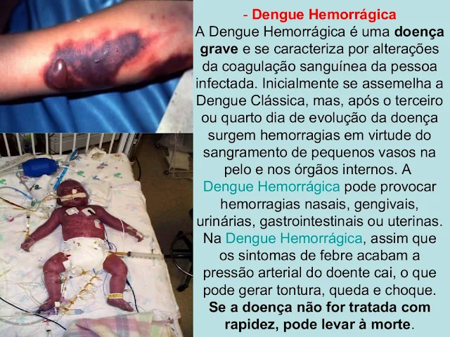 Dengue Hemorrágica 