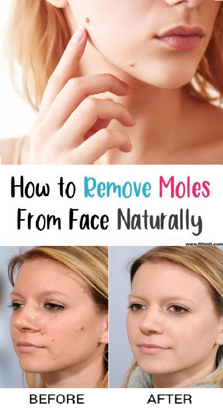 How To Remove Moles From Your Face Naturally And Quickly? Beauty