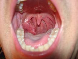 Tonsil Cancer Picture