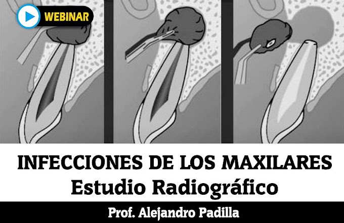 INFECCIONES DE LOS MAXILARES: Estudio Radiográfico - Prof. Alejandro Padilla