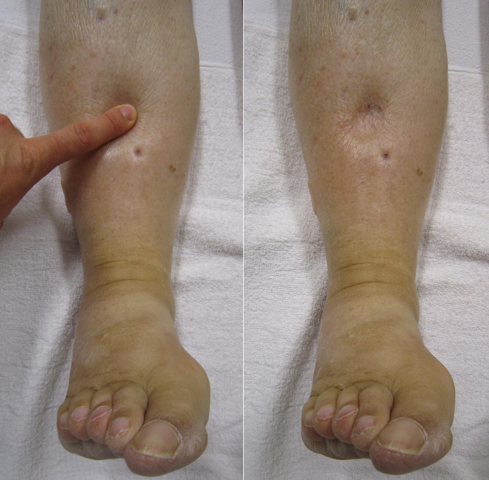Health Encylopedia [ Health Home Page ] swelling in legs causes