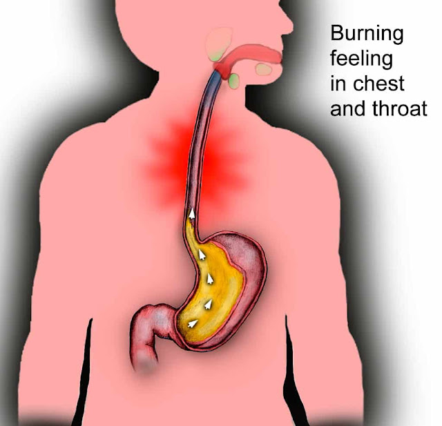 foods that help acid reflux go away,esophagus