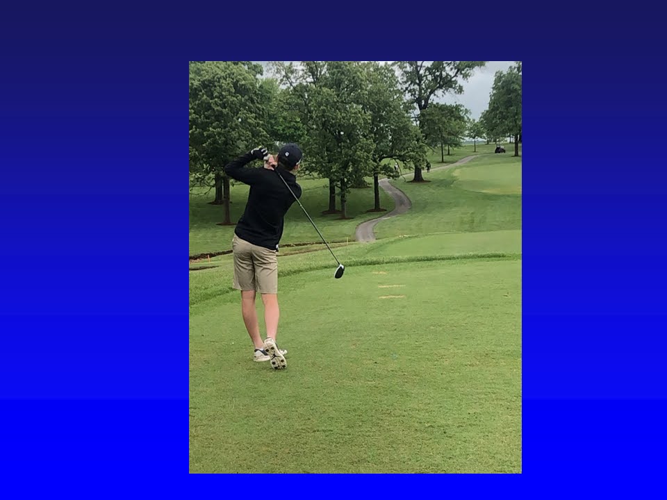 Sports after Posterior Spinal Fusion T2L2, 1 year postoperative