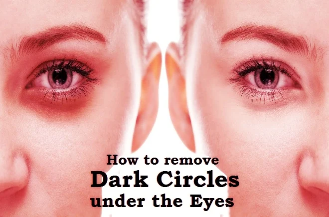 Dark circles under the eyes
