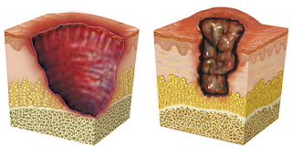 Avian Flu Diary: MJA & EID Journal On The Rise Of Buruli Ulcer In Australia