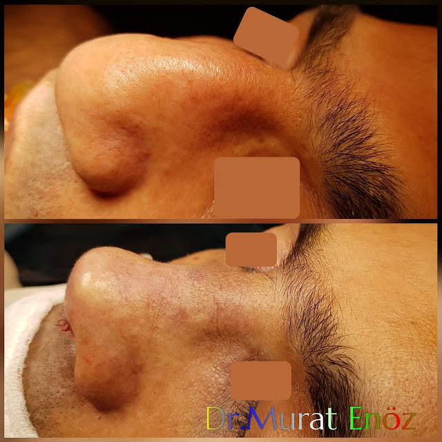 Revision Rhinoplasty in Istanbul