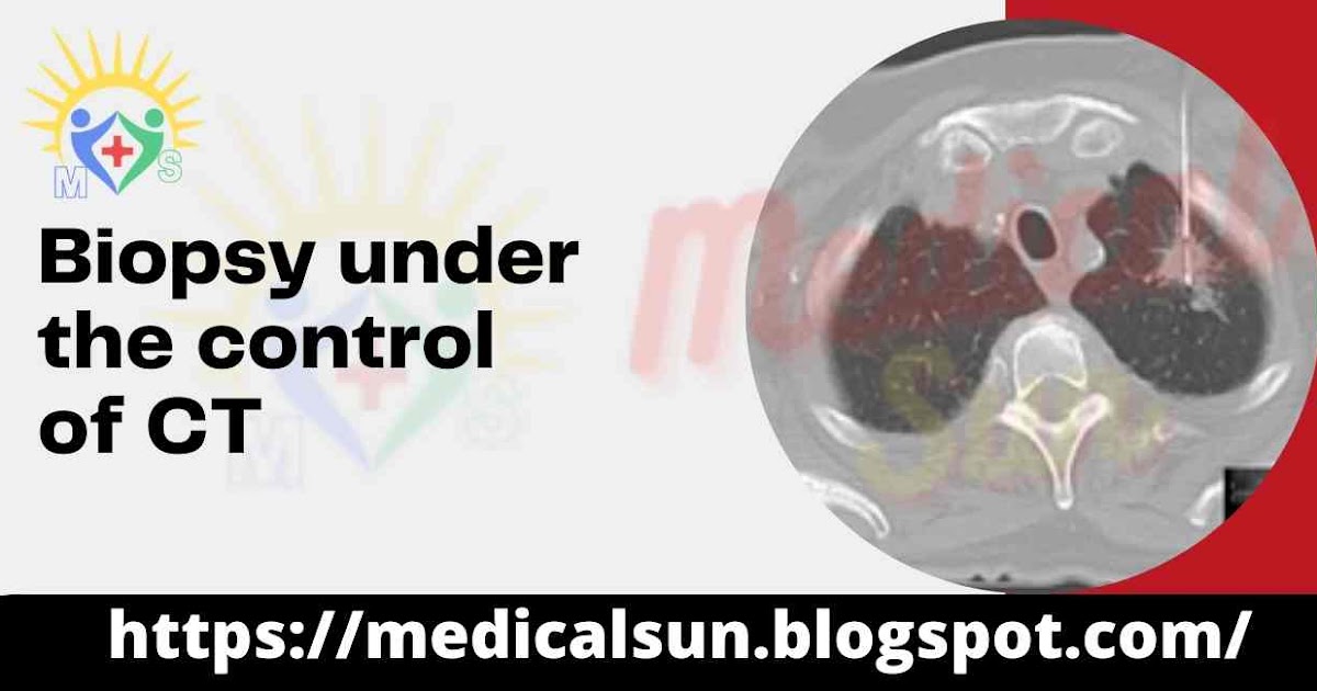 Biopsy under the control of CT 2021 Medical Sun