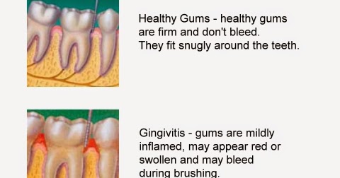 North Creek Dental Care: What are the Stages of Gum Disease?