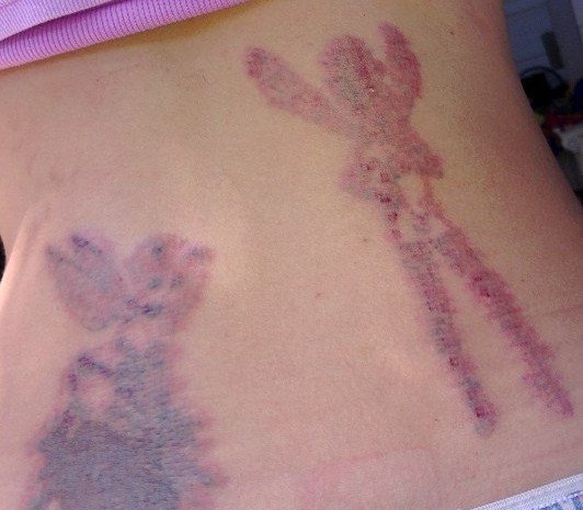 My tattoo removal process: Day 2: Healing nicely the day after laser ...