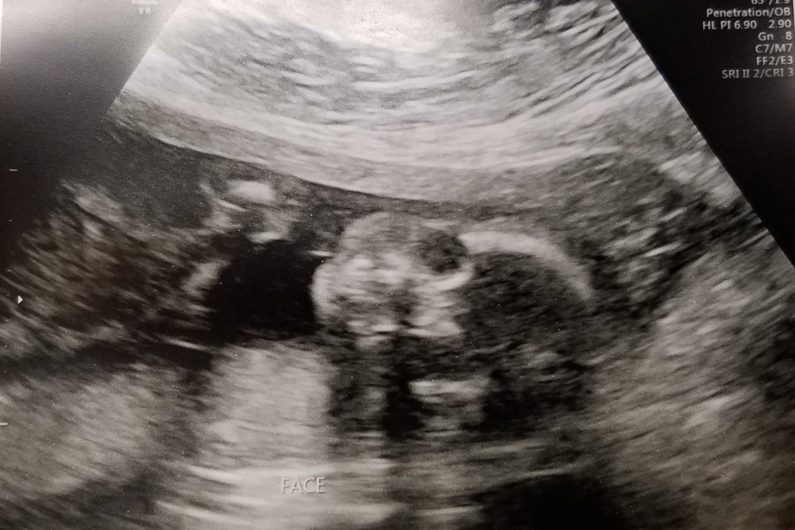 The Hahnstadts Anatomy Scan + 21 Weeks