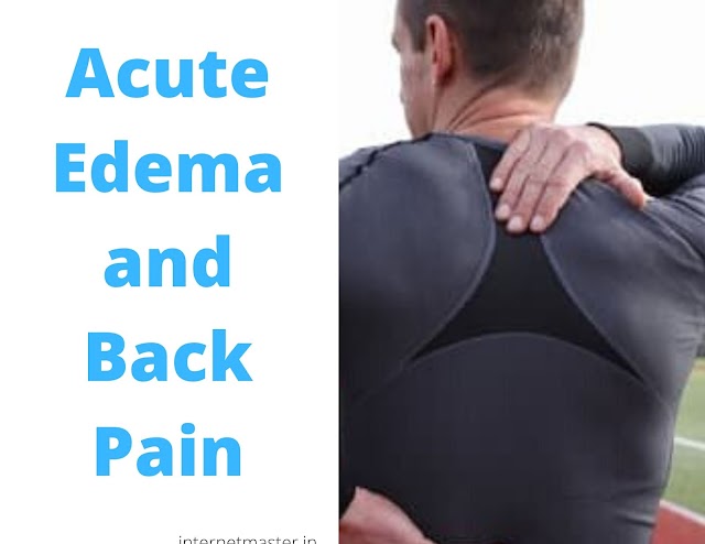 Acute Edema and Back Pain