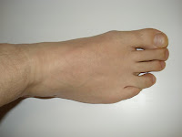 Big toe (jempol kaki) Big toe (jempol kaki)