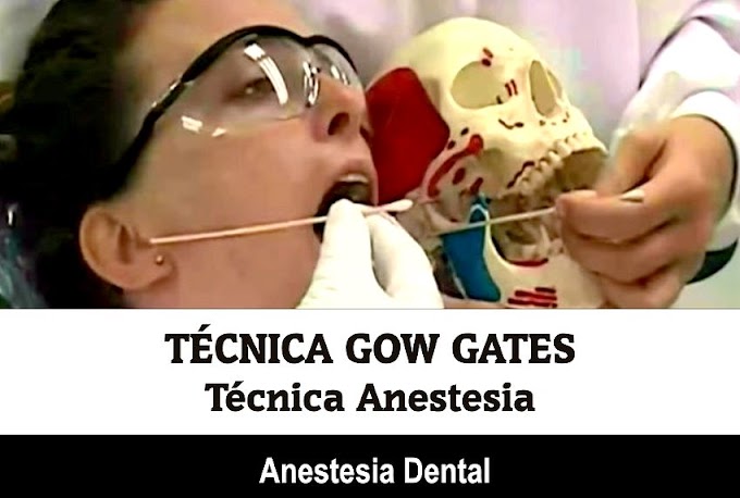 ANESTESIA DENTAL: Técnica anestésica de Gow Gates