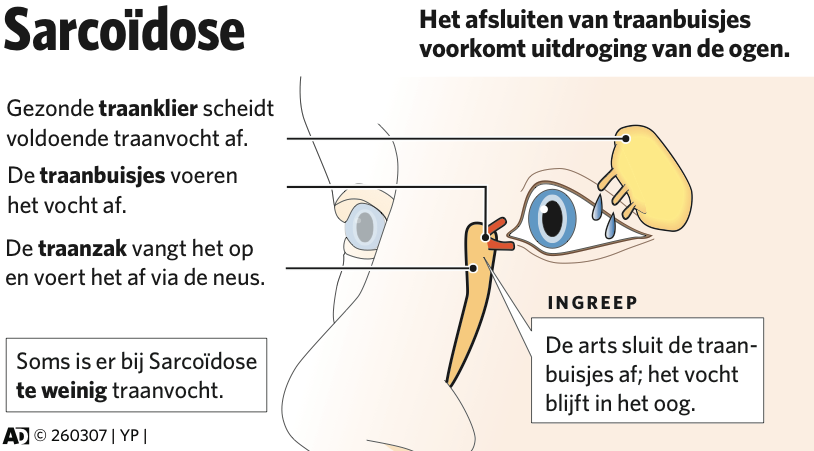 Ymke's Infographics: Afsluiten traanbuisjes